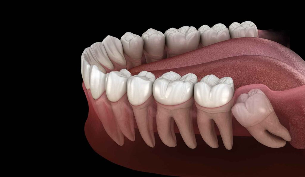Operculectomy