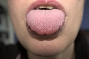 Scalloped Tongue