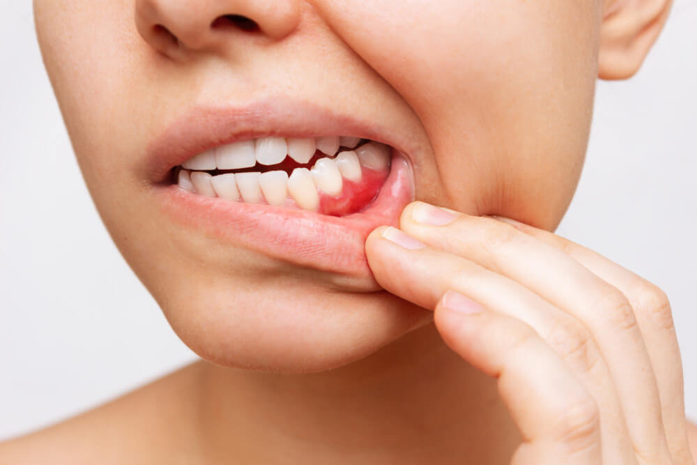 Is gum disease contagious