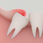 How to Clean under Gum Flap Wisdom Tooth