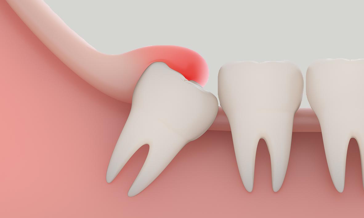 How to Clean under Gum Flap Wisdom Tooth
