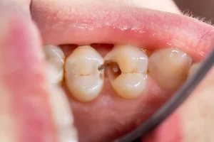 Cavity in Between Teeth