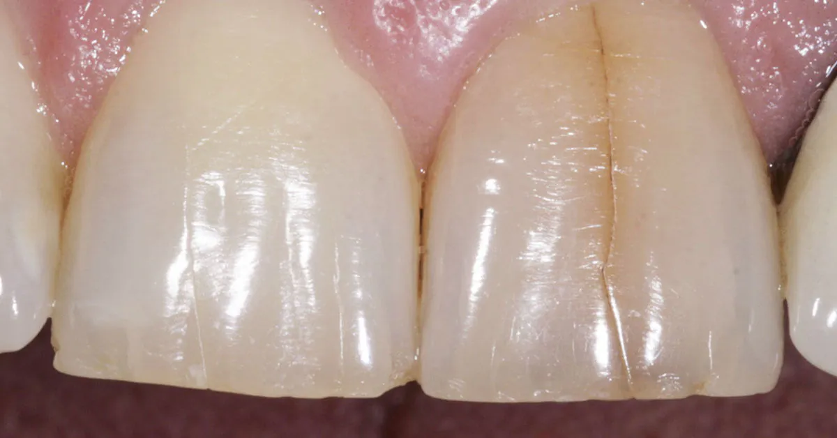 What You Need to Know About Craze Lines Teeth