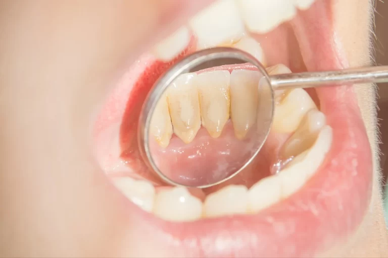 tartar-on-teeth-dental-calculus