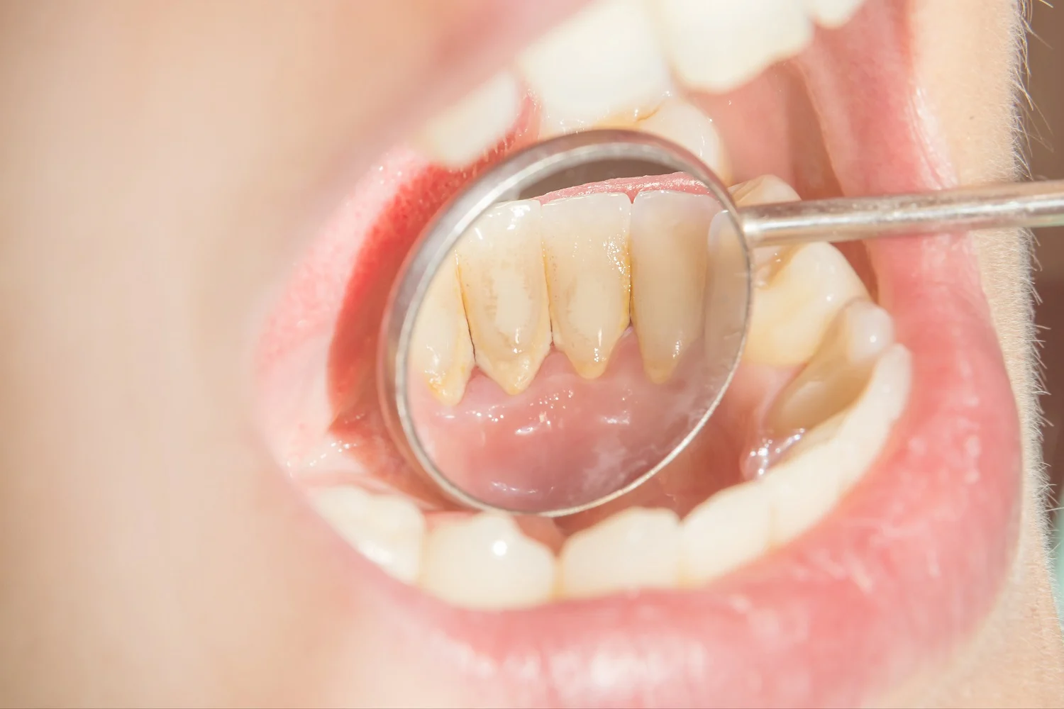Tartar on Teeth (Dental Calculus)