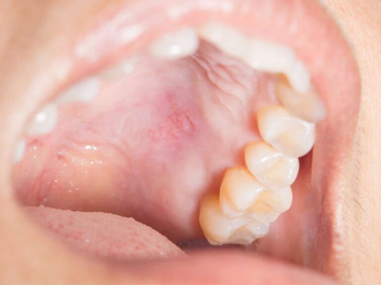What causes a Bump on the Roof of Mouth?