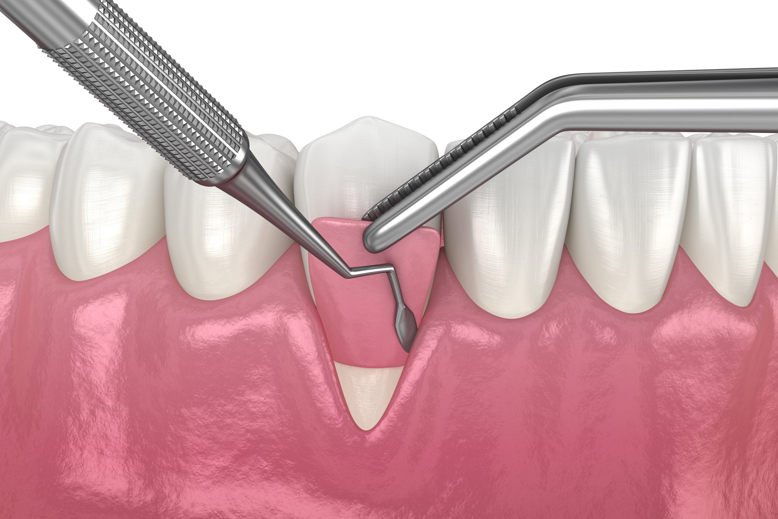 Failed Gum Graft? Here Is What to Do