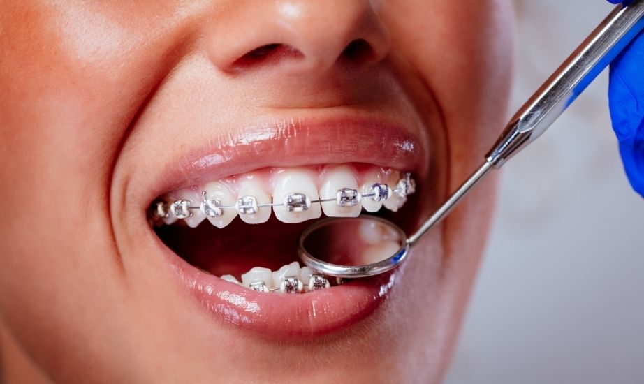 How To Whiten Teeth With Braces