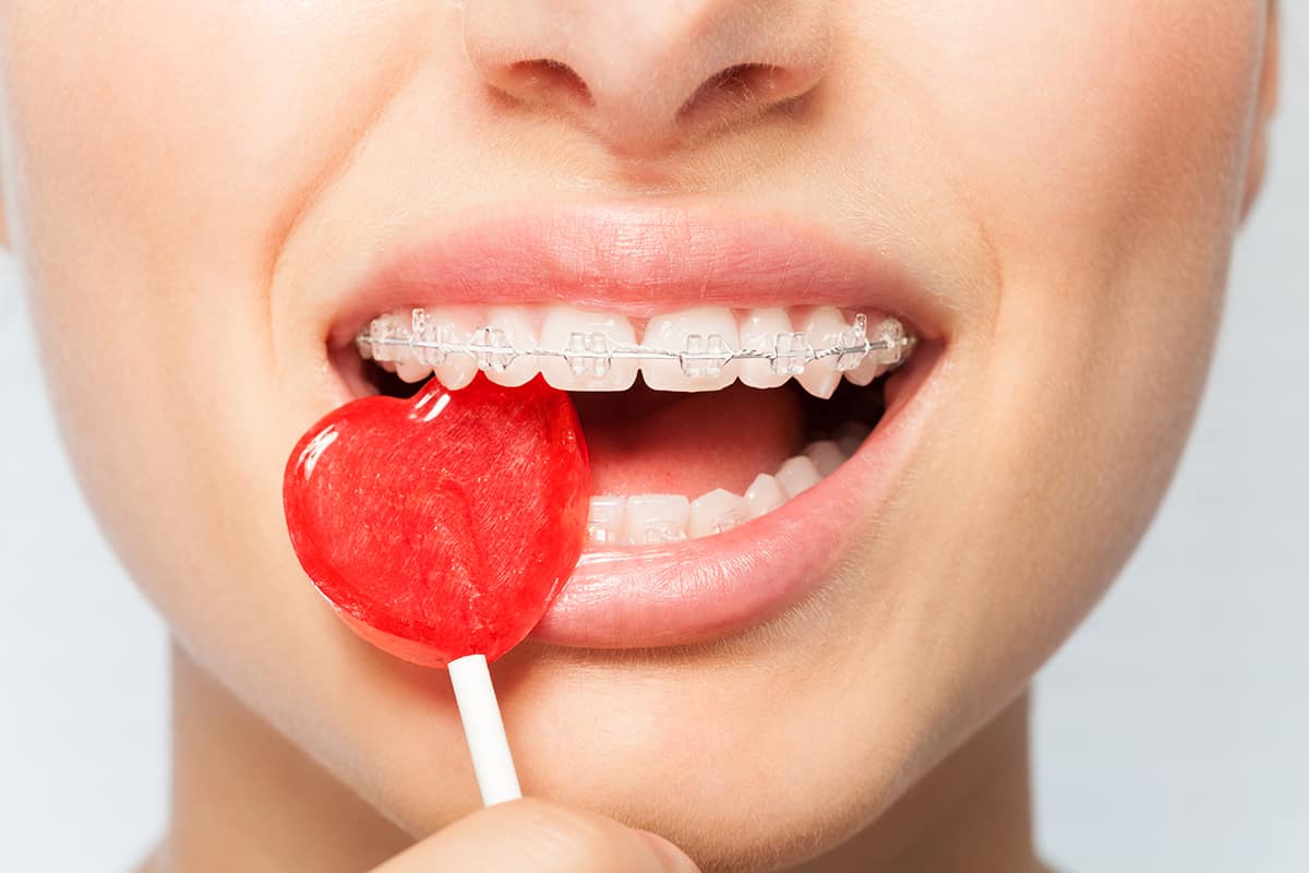 What Candy Can You Eat With Braces | Braces-Friendly Sweets