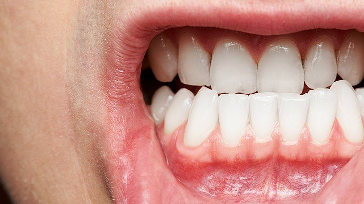 White Gums: Causes & Treatments